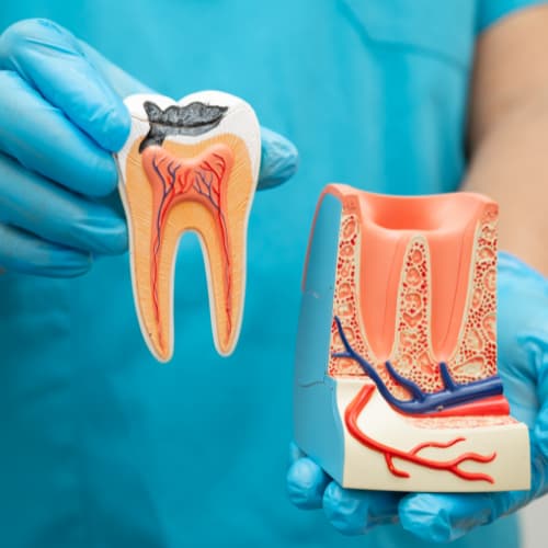 Root Canal