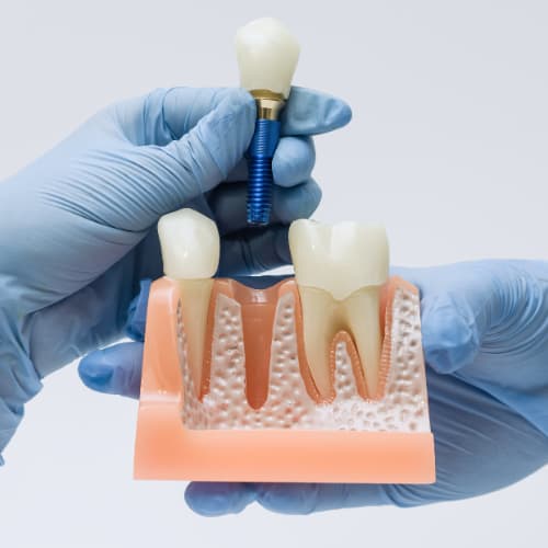 Dental Implants