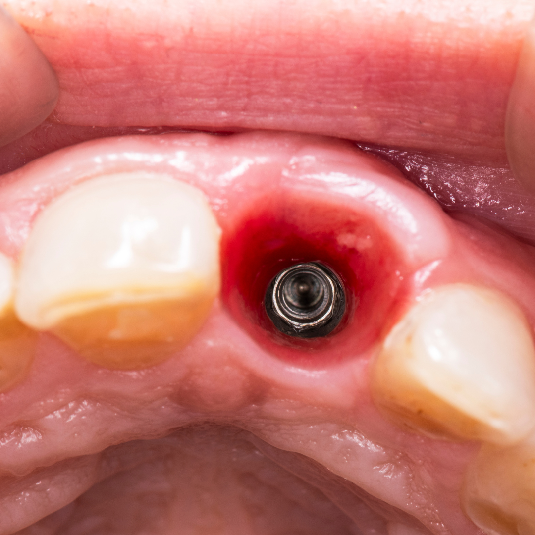 After Treatment