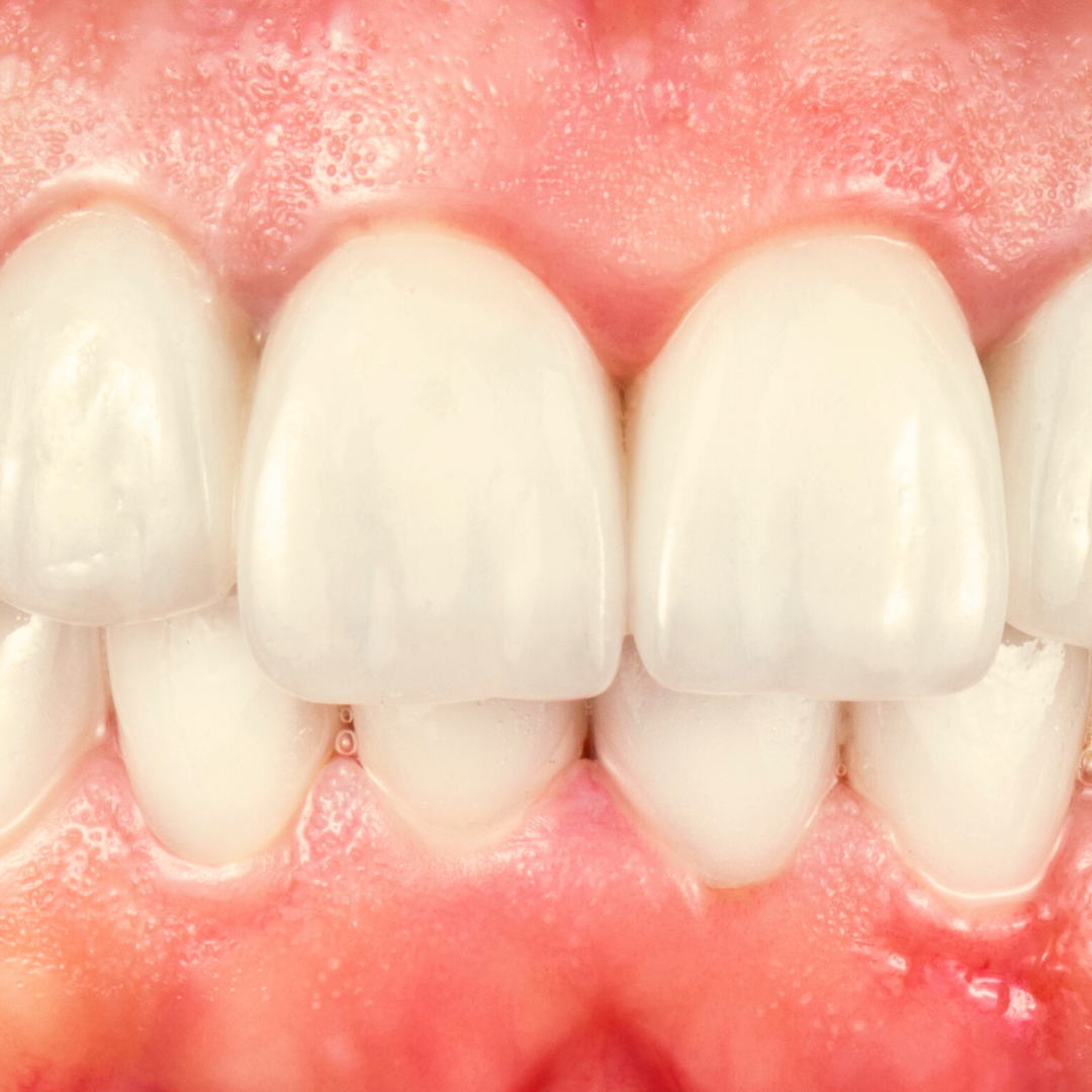 Before Treatment
