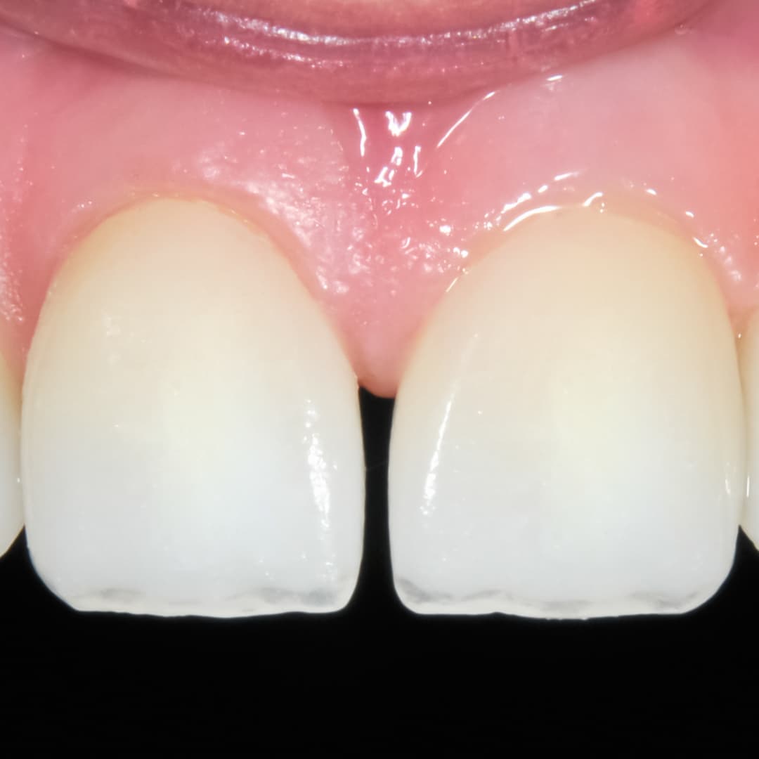 Before Treatment