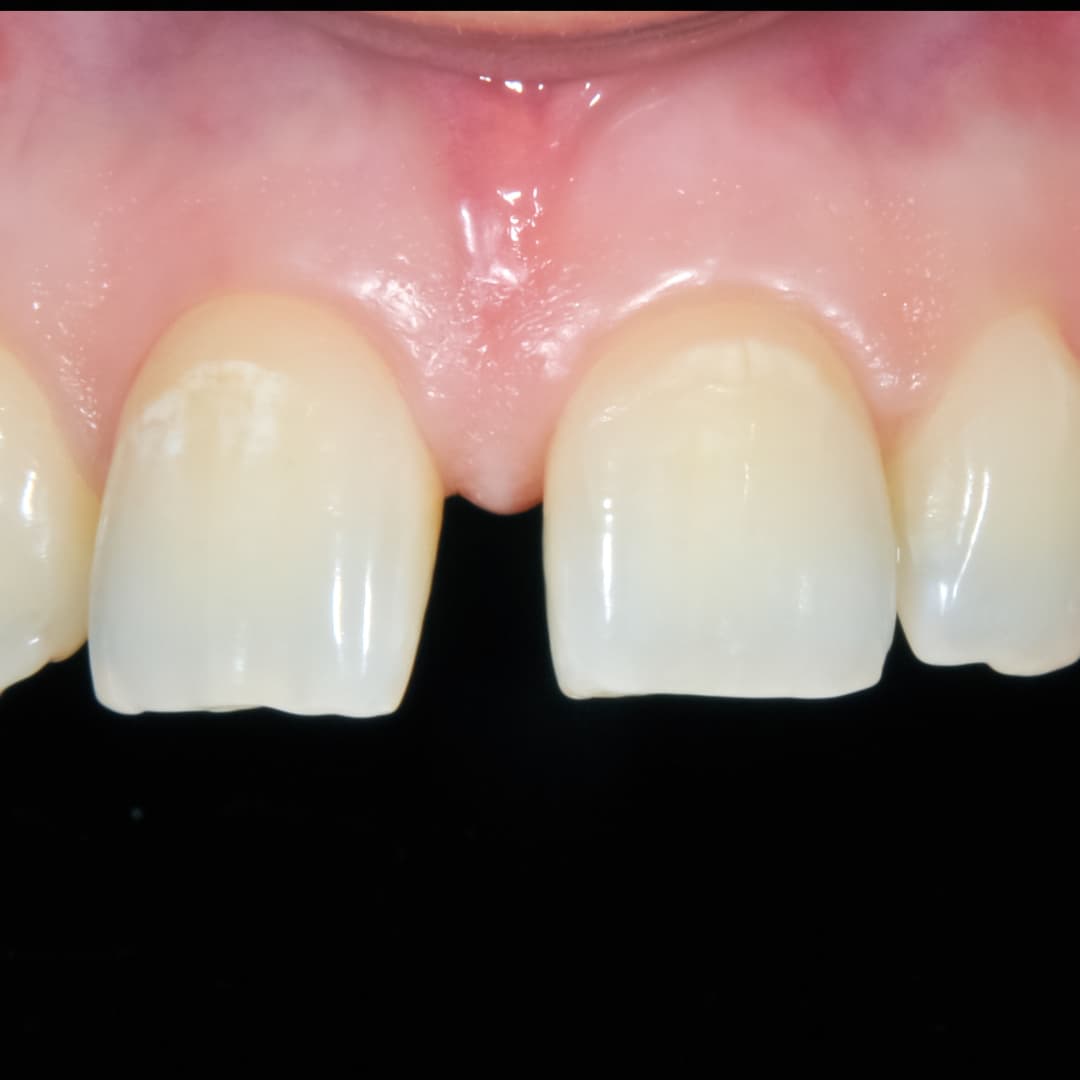 After Treatment