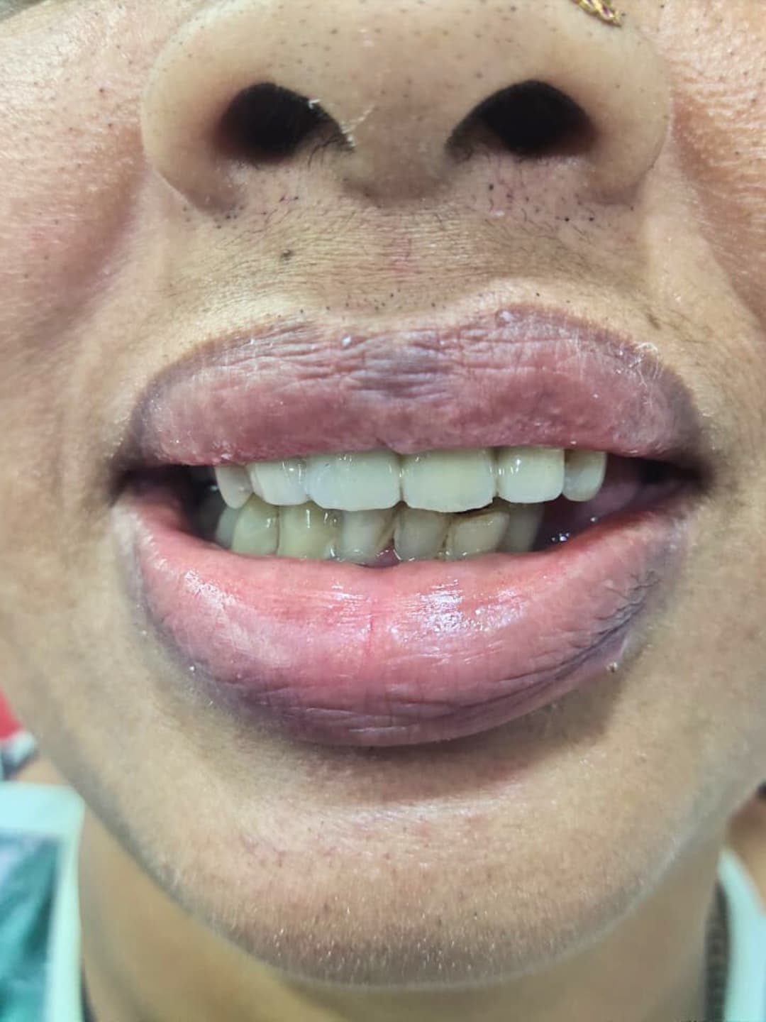 Before Treatment