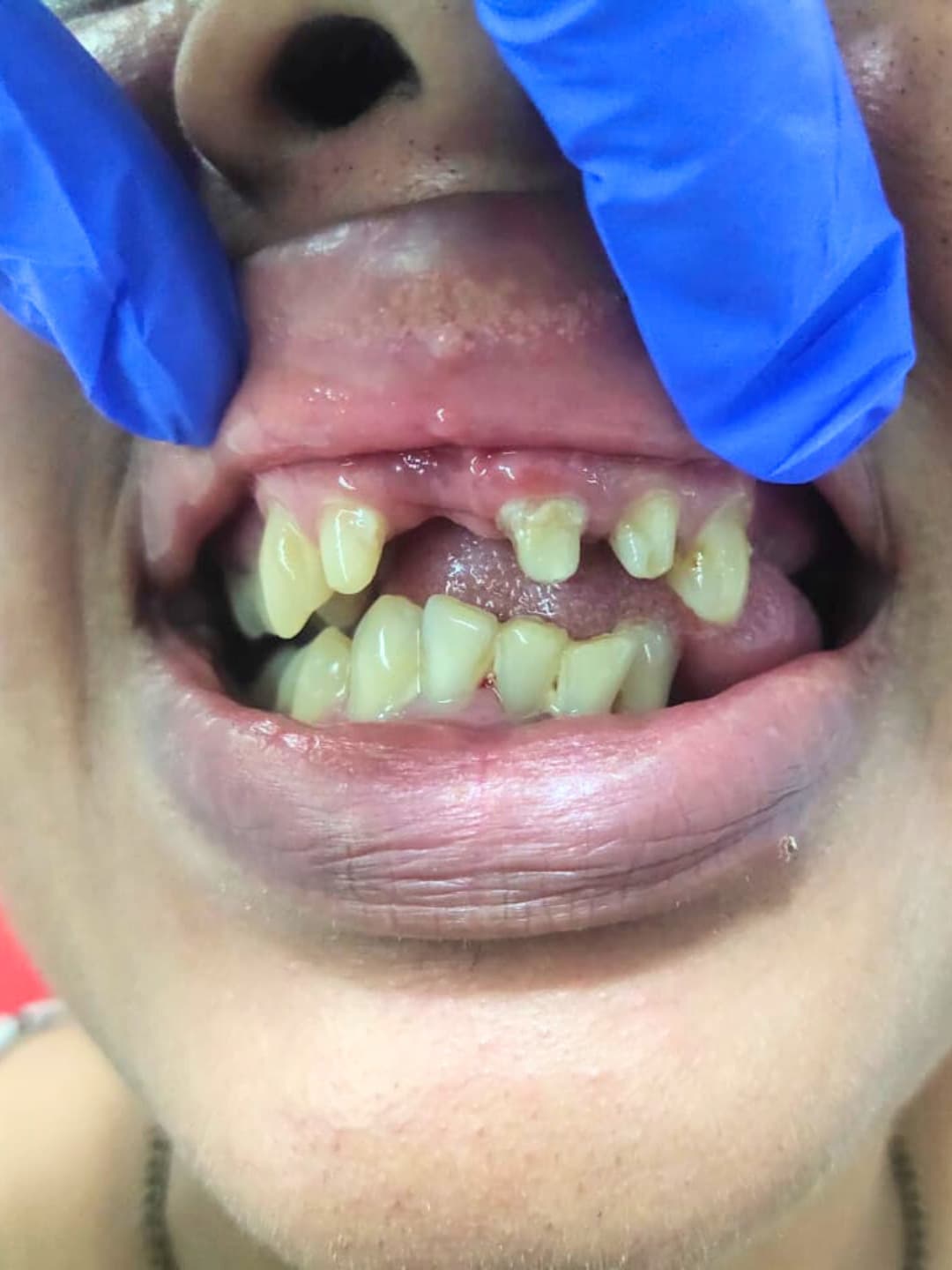 After Treatment
